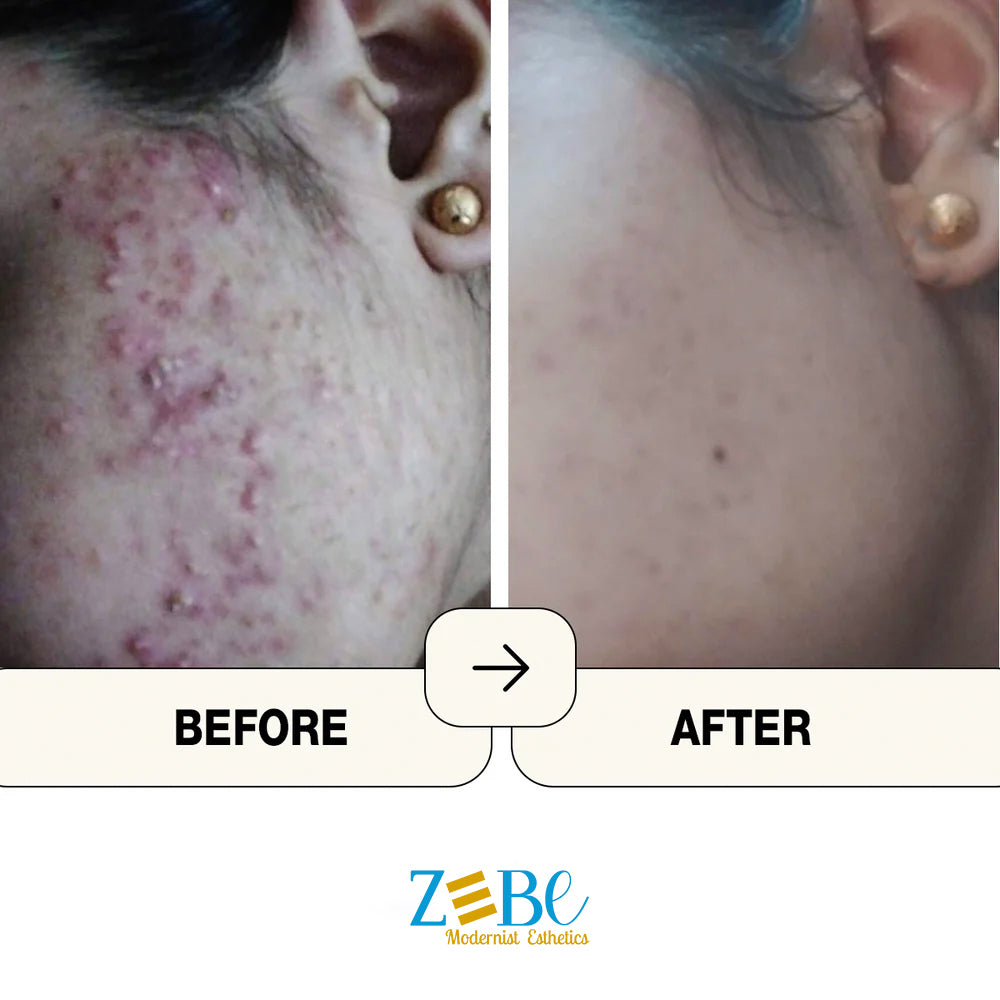 Acne Reset Clear Skin Trio