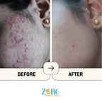 Acne Reset Clear Skin Trio