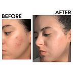 Acne Reset Clear Skin Trio