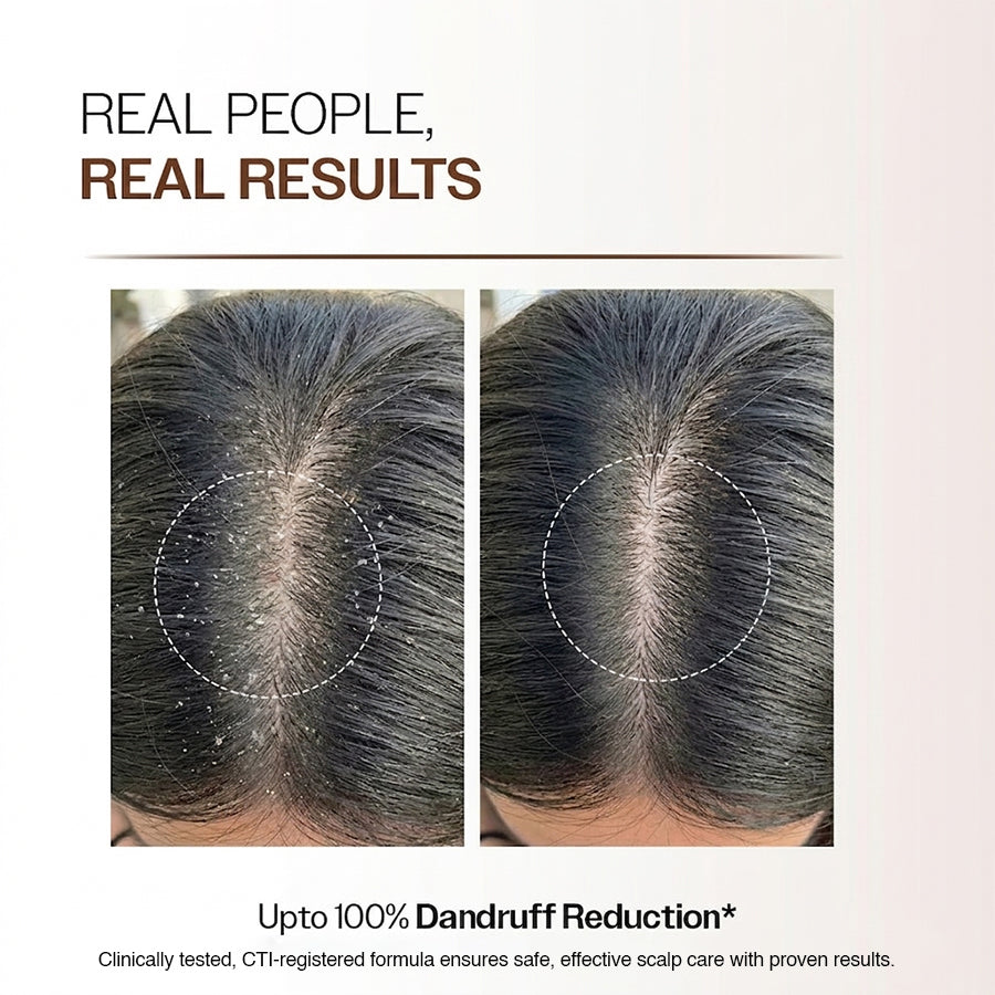 Pro Clear Anti-Dandruff Scalp Lotion (30ml)